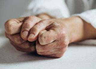 Lo studio, inibitore Il-23 riduce segni e sintomi artrite psoriasica attiva