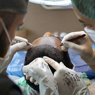 Perché gli uomini amano i trapianti di capelli FUE in Albania Perché gli uomini amano i trapianti di capelli FUE in Albania