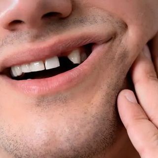 Denti mancanti? Ecco le migliori soluzioni per ritrovare il sorriso