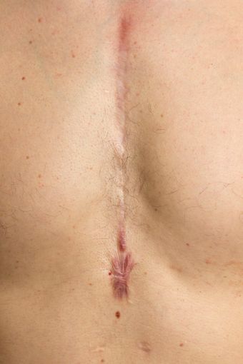 Cicatrici ipertrofiche