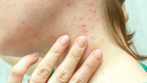 Primo caso di vaiolo delle scimmie in Canton Ticino Primo caso di vaiolo delle scimmie in Canton Ticino