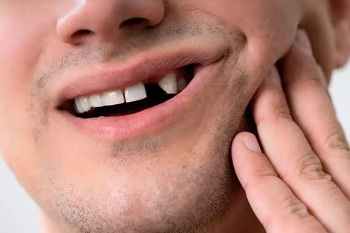 Denti mancanti? Ecco le migliori soluzioni per ritrovare il sorriso