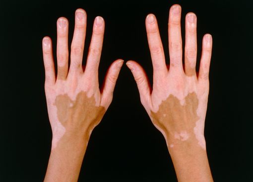 Vitiligine Vitiligine