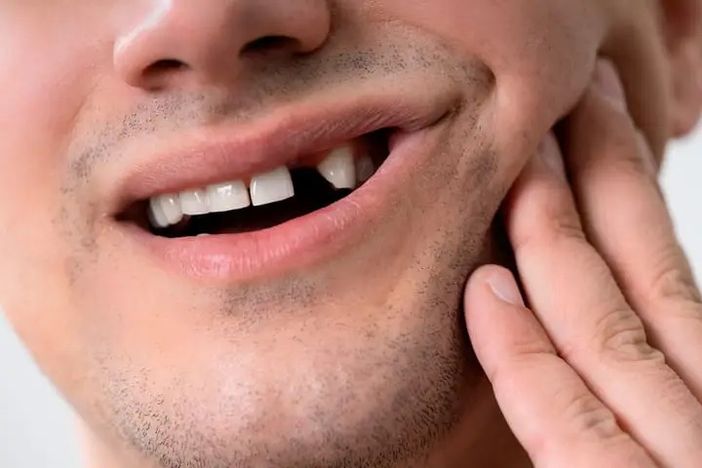 Denti mancanti? Ecco le migliori soluzioni per ritrovare il sorriso