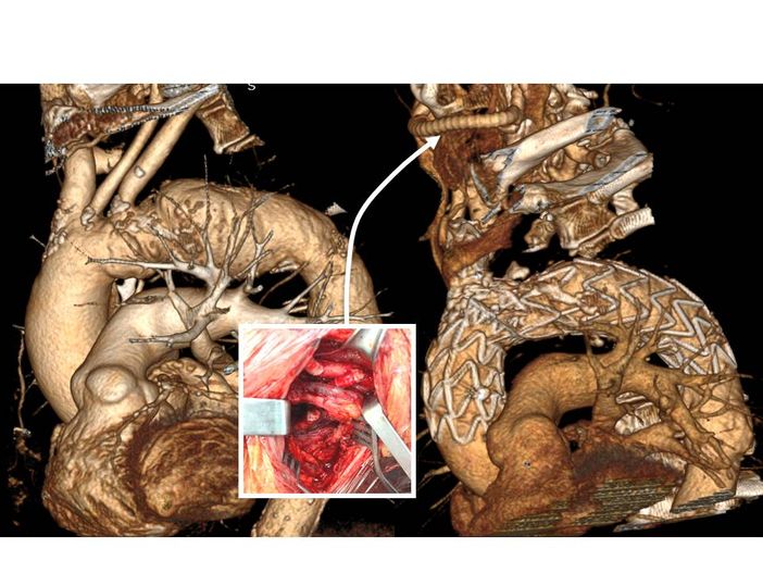 La Chirurgia Vascolare varesina nel ristretto gruppo di quelle che in Italia hanno impiantato un'endoprotesi ramificata La Chirurgia Vascolare varesina nel ristretto gruppo di quelle che in Italia hanno impiantato un'endoprotesi ramificata