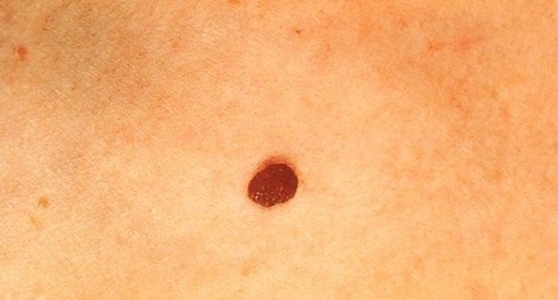 Alla Casa della Comunità di Tradate l’open day per la prevenzione del melanoma