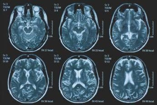 Una persona su 3 ha un disturbo neurologico, a Napoli arriva BrainSpace House