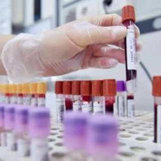 Test del sangue può escludere rischio demenza fino a 10 anni prima, lo studio