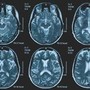 Una persona su 3 ha un disturbo neurologico, a Napoli arriva BrainSpace House Una persona su 3 ha un disturbo neurologico, a Napoli arriva BrainSpace House