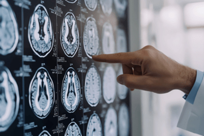 Parkinson, ansia e depressione possono essere segnali precoci: lo studio