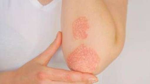Psoriasi, dati positivi per inibitore orale di Tyk2 di nuova generazione