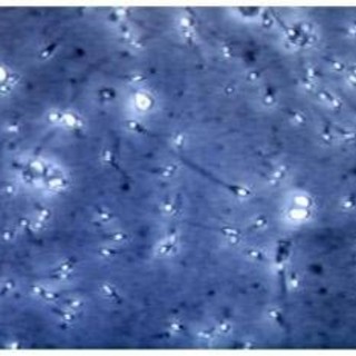 Microplastiche nella prostata e nel liquido seminale, la scoperta italiana: cosa comporta